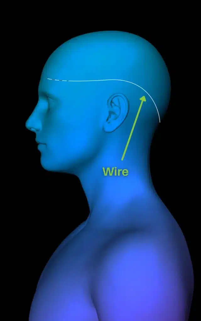 usmigraine_ Reed Procedure Side View.png